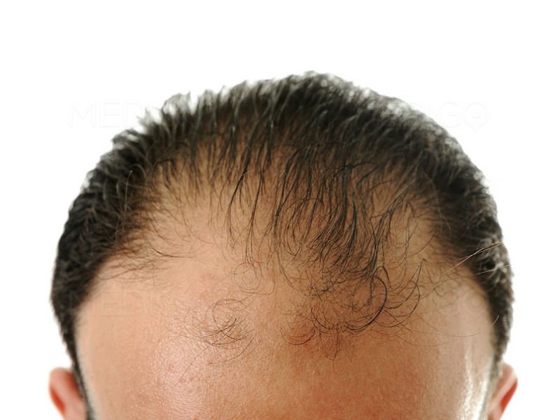Microgreffe cheveux : Définition et explication