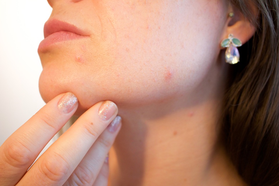 himmelen-Le rhassoul ou ghassoul pour éliminer l’acné, voici comment faire