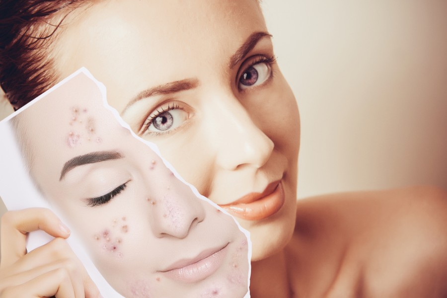 Peeling visage acné : causes, symptômes, traitement, diagnostic