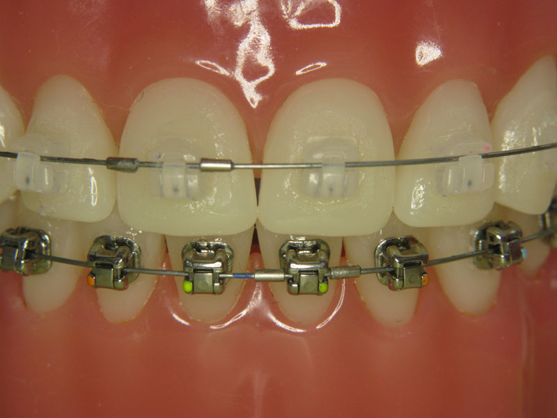 himmelen-Les différents traitements orthodontiques