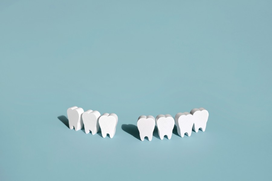 Qu'est-ce que l'agénésie dentaire et comment la gérer ?