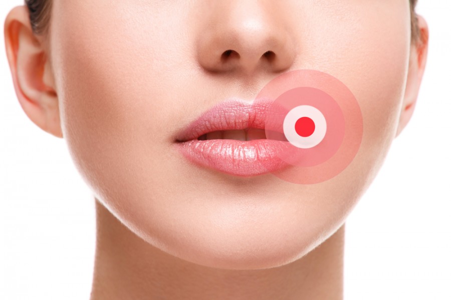 himmelen-Bouton de fievre huile essentielle : optez pour un traitement naturel