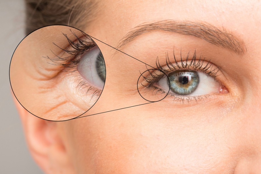 himmelen-Laser pour les cernes, est-ce une solution efficace ?