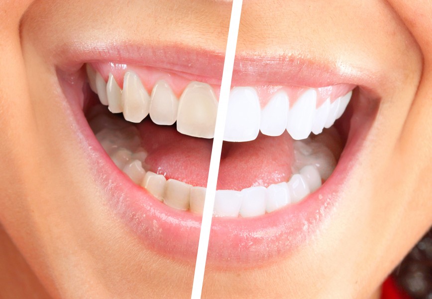 Utiliser l'eau oxygénée pour des dents blanches : est-ce une bonne idée ?