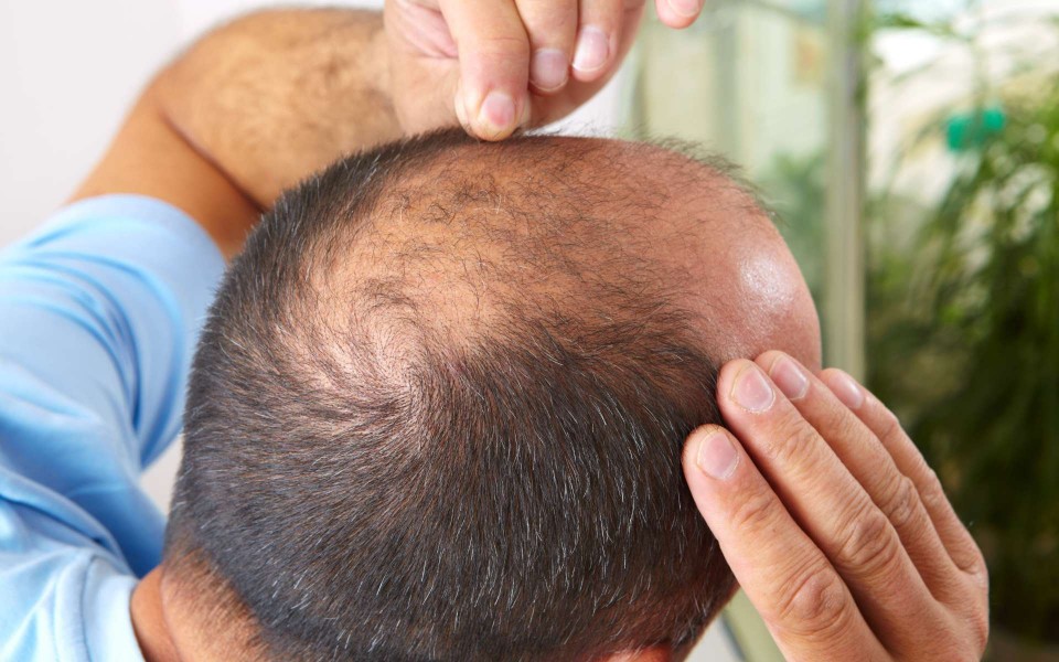 himmelen-Implant cheveux : quelles solutions ?