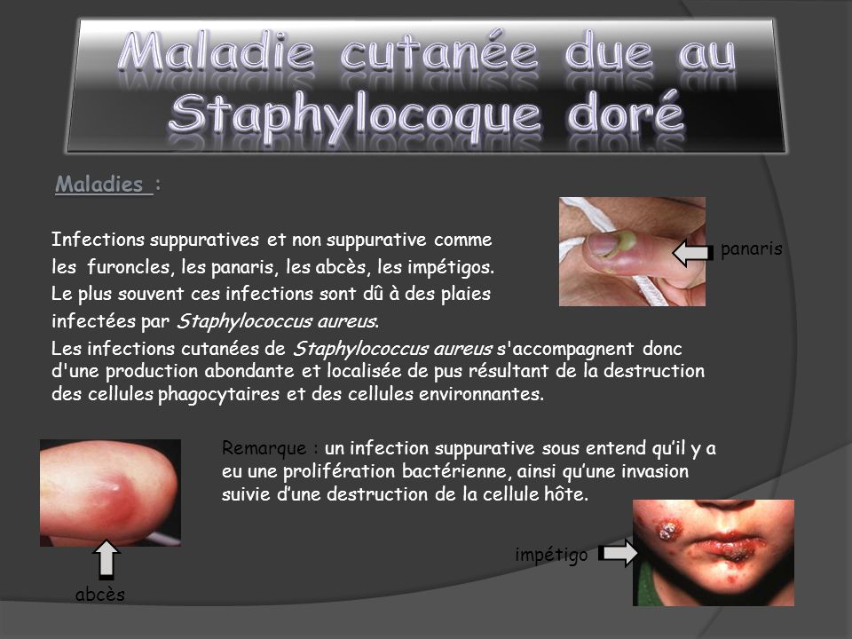 Comment se débarrasser du staphylocoque doré ?