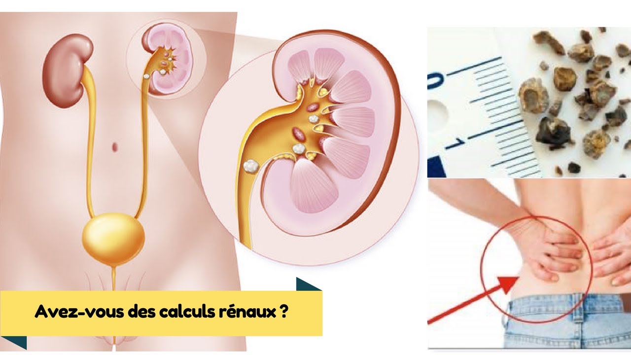 Quels sont les symptômes du calcul rénal ?